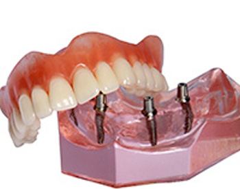 Model smile with implant dentures