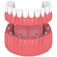 implant-retained denture