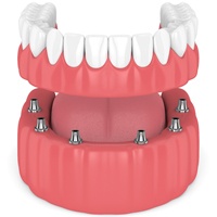 implant-retained denture