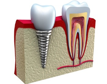 digital illustration of a dental implant next to a tooth for comparison 	