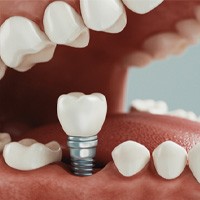 Digital illustration of a single dental implant being placed