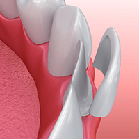 Model of veneer for lower tooth