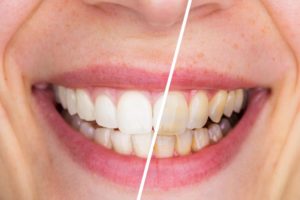 Whitened smile before and after visiting San Antonio cosmetic dentist