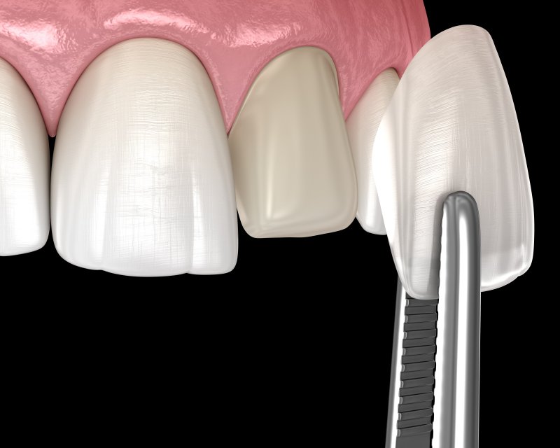 3-D model of a veneer being applied